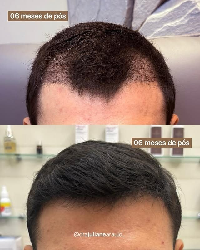Antes e depois de transplante capilar — densidade no topo, 6 meses