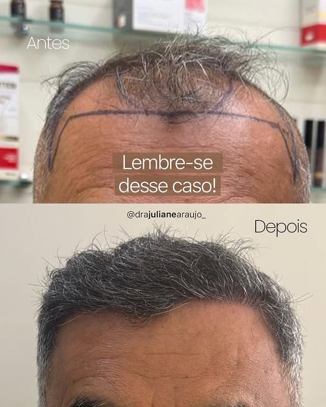 Antes e depois de transplante capilar — reconstrução da linha frontal