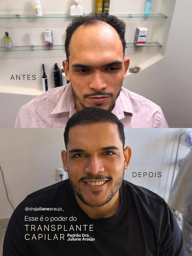 Antes e depois de transplante capilar — transformação completa